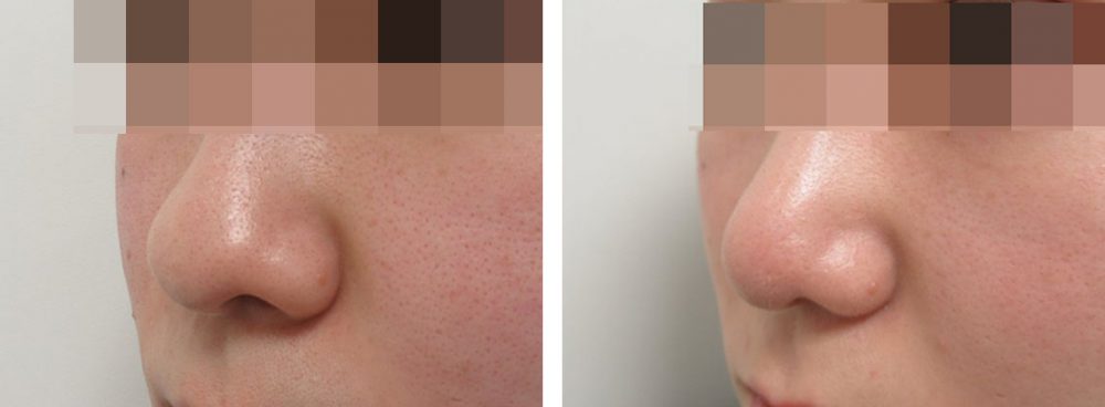 TAC式 鼻翼縮小術（小鼻縮小）/鼻尖形成・鼻尖縮小の症例写真 施術前後 １ヵ月