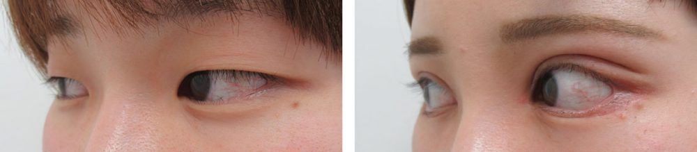 二重切開（全切開法）/眼瞼下垂（目つき矯正）/目頭切開術の症例写真 施術前後 １ヵ月