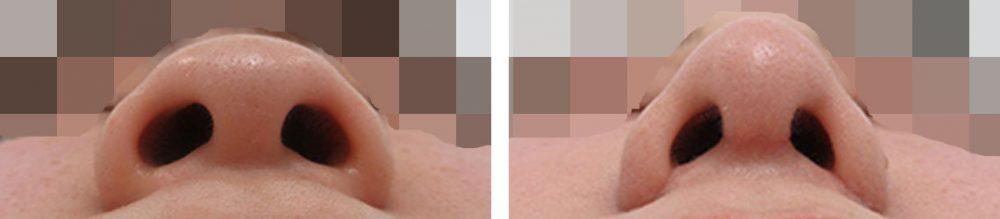 TAC式 鼻翼縮小術（小鼻縮小）/鼻尖形成・鼻尖縮小の症例写真 施術前後 １ヵ月