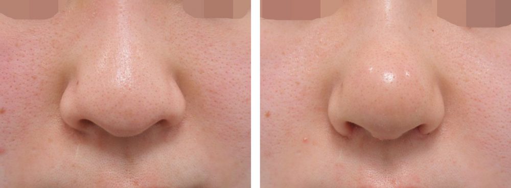 TAC式 鼻翼縮小術（小鼻縮小）/鼻尖形成・鼻尖縮小の症例写真 施術前後 １週間