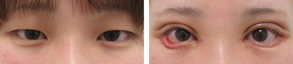 二重切開（全切開法）/眼瞼下垂（目つき矯正）/目頭切開術の症例写真 施術前後 １週間