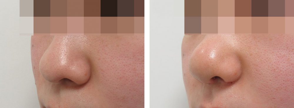 TAC式 鼻翼縮小術（小鼻縮小）/鼻尖形成・鼻尖縮小の症例写真 施術前後 １週間