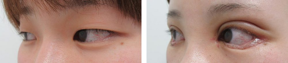 二重切開（全切開法）/眼瞼下垂（目つき矯正）/目頭切開術の症例写真 施術前後 １週間
