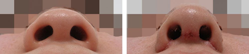 TAC式 鼻翼縮小術（小鼻縮小）/鼻尖形成・鼻尖縮小の症例写真 施術前後 １週間