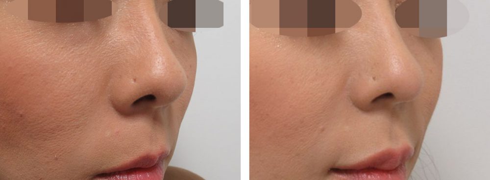 鼻先のお悩みは鼻尖４Dノーズで解決