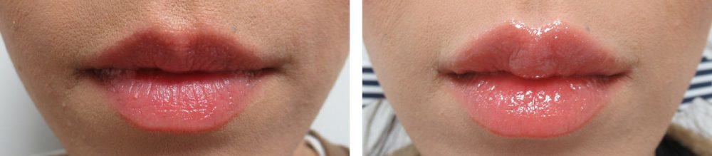 TAC式アヒル口形成で唇を華やかな印象に