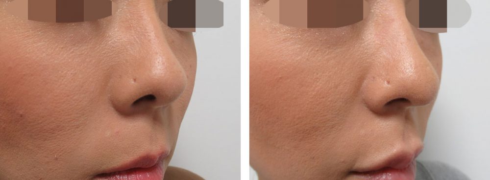 鼻尖4Dノーズの症例写真 施術前後 １週間