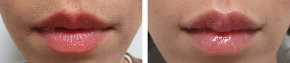 の症例写真 施術前後 １週間