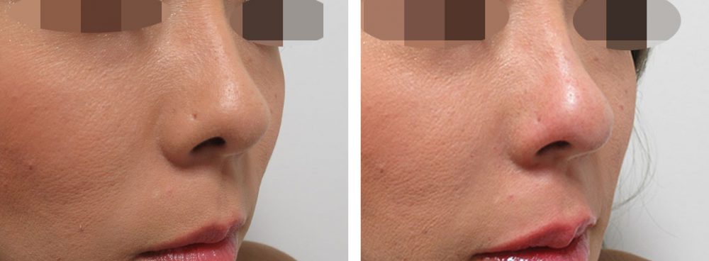 鼻尖4Dノーズの症例写真 施術前後 直後