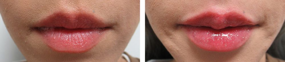 の症例写真 施術前後 直後