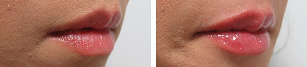 の症例写真 施術前後 直後