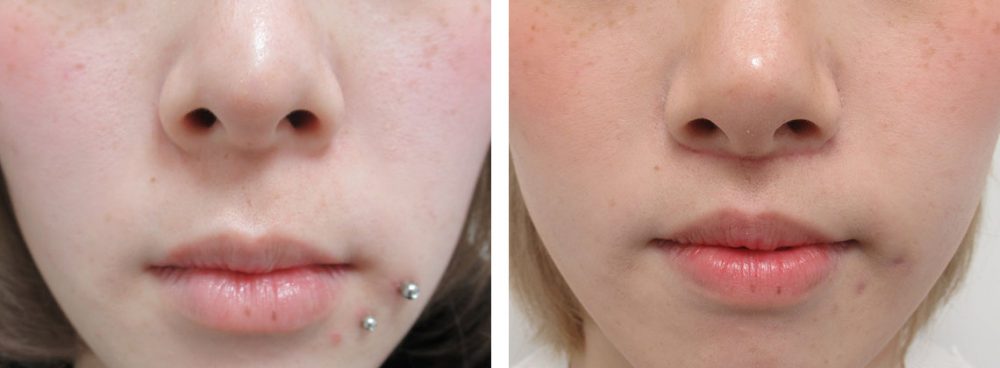 色白の方の傷の参考に