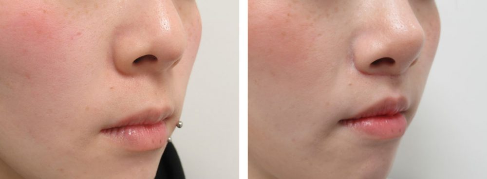 人中短縮術(リップリフト)・外側人中短縮術/TAC式 鼻翼縮小術（小鼻縮小）の症例写真 施術前後 １ヵ月