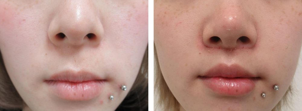 人中短縮術(リップリフト)・外側人中短縮術/TAC式 鼻翼縮小術（小鼻縮小）の症例写真 施術前後 １週間