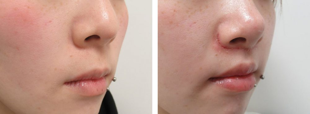 人中短縮術(リップリフト)・外側人中短縮術/TAC式 鼻翼縮小術（小鼻縮小）の症例写真 施術前後 １週間