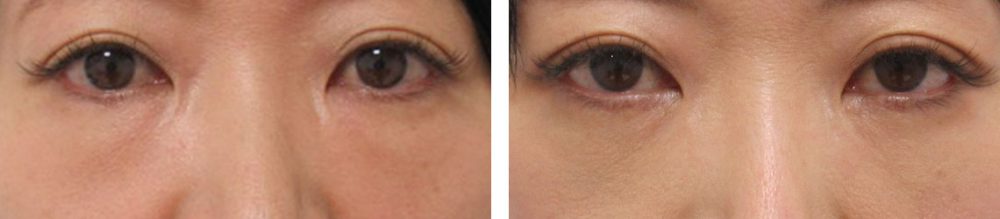 下眼瞼脱脂術(目の下のたるみ取り・目の下の脂肪ふくらみ取り)の症例写真 施術前後 1ヵ月