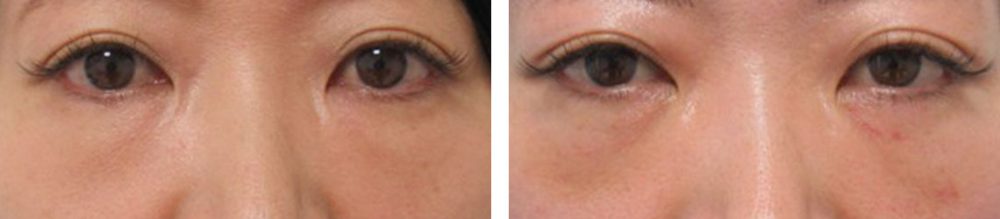 下眼瞼脱脂術(目の下のたるみ取り・目の下の脂肪ふくらみ取り)の症例写真 施術前後 1週間