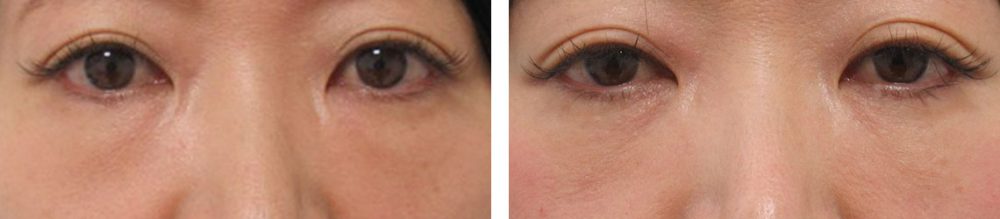 下眼瞼脱脂術(目の下のたるみ取り・目の下の脂肪ふくらみ取り)の症例写真 施術前後 3ヵ月