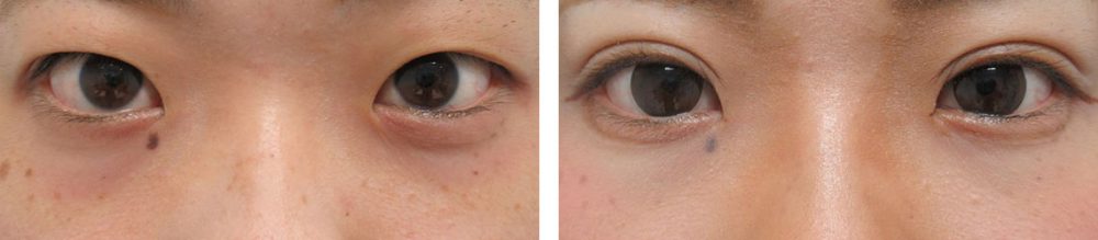 二重埋没法の症例写真 施術前後 １ヵ月