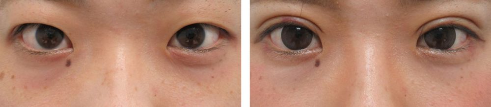 二重埋没法の症例写真 施術前後 １週間