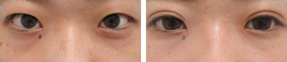 埋没法でメイクがしやすい目元に