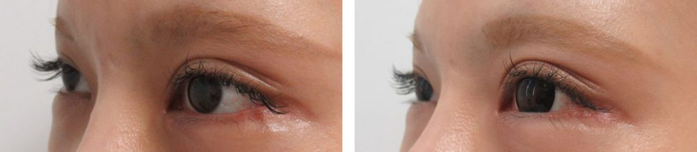 目尻靭帯移動術の症例写真 施術前後 １ヵ月