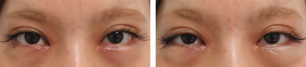 目尻靭帯移動術の症例写真 施術前後 直後