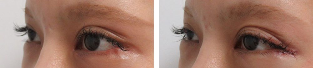 目尻靭帯移動術の症例写真 施術前後 直後