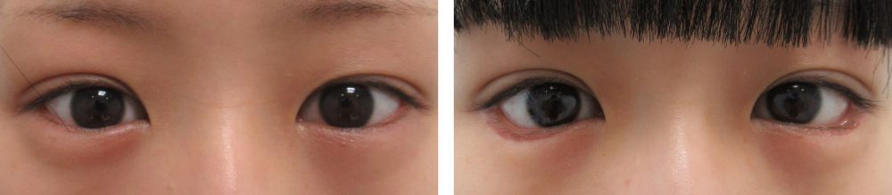 グラマラスライン(タレ目形成)の症例写真 施術前後 1ヵ月