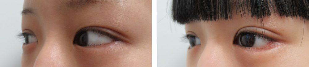 グラマラスライン(タレ目形成)の症例写真 施術前後 1ヵ月