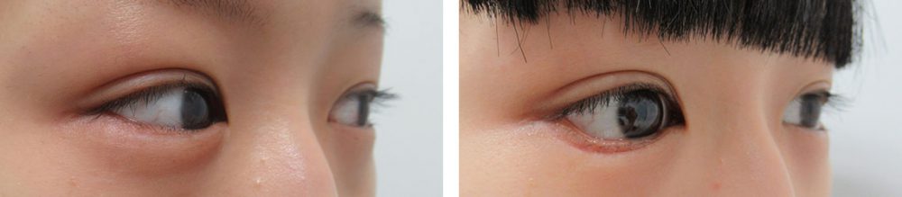 グラマラスライン(タレ目形成)の症例写真 施術前後 1ヵ月