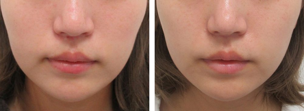 鼻尖４Dノーズで流行りのお鼻に