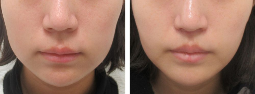 人中短縮術(リップリフト)・外側人中短縮術/TAC式 鼻翼縮小術（小鼻縮小）/鼻孔縁挙上術の症例写真 施術前後 １ヵ月