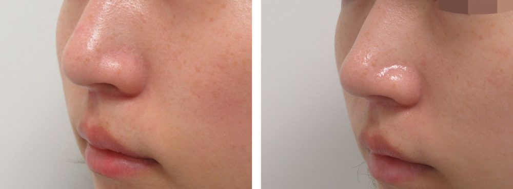 鼻尖4Dノーズ/鼻尖形成・鼻尖縮小の症例写真 施術前後 １ヵ月