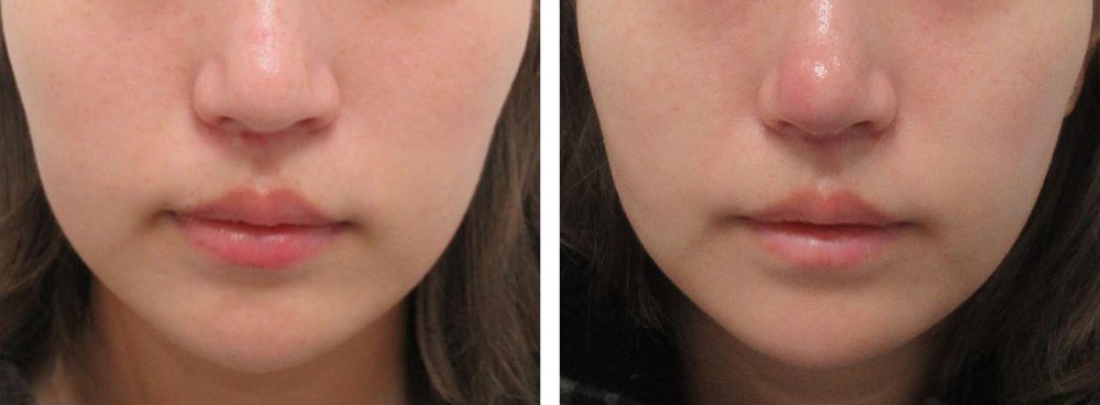 鼻尖4Dノーズ/鼻尖形成・鼻尖縮小の症例写真 施術前後 １週間