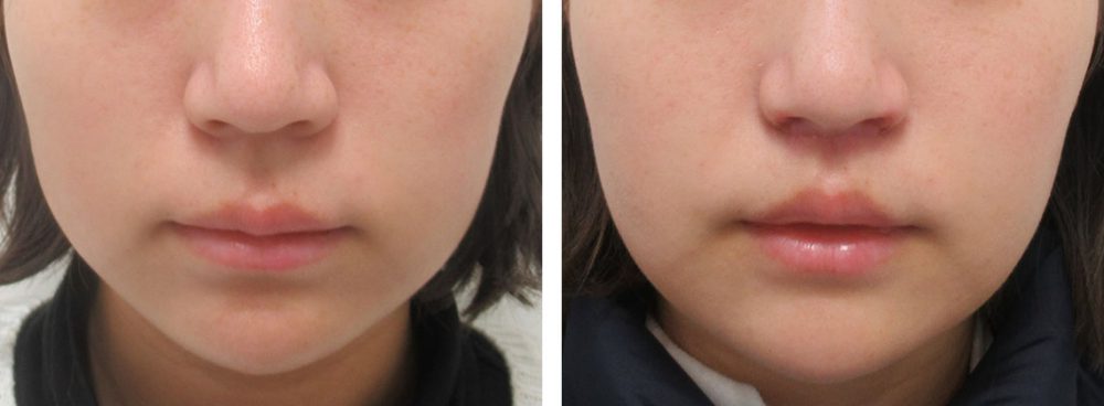 人中短縮術(リップリフト)・外側人中短縮術/TAC式 鼻翼縮小術（小鼻縮小）/鼻孔縁挙上術の症例写真 施術前後 １週間