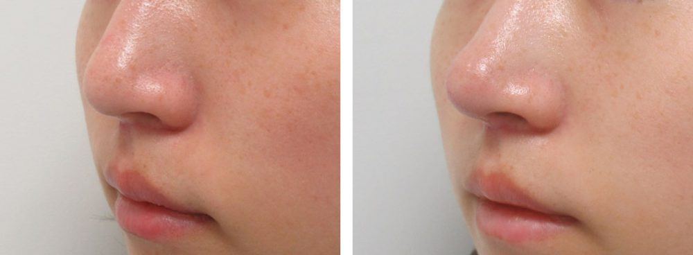鼻尖4Dノーズ/鼻尖形成・鼻尖縮小の症例写真 施術前後 １週間