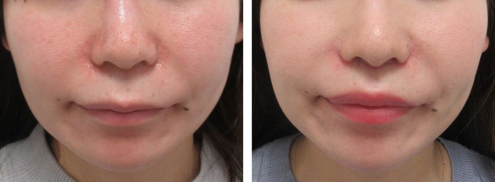 人中短縮は面長解消にも効果的です