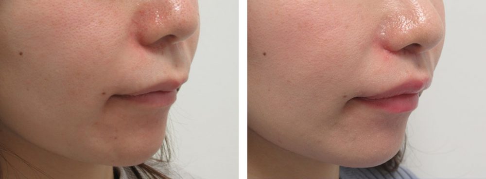 人中短縮術(リップリフト)・外側人中短縮術の症例写真 施術前後 １ヵ月
