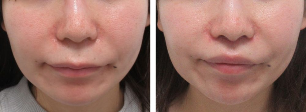 人中短縮術(リップリフト)・外側人中短縮術の症例写真 施術前後 １週間