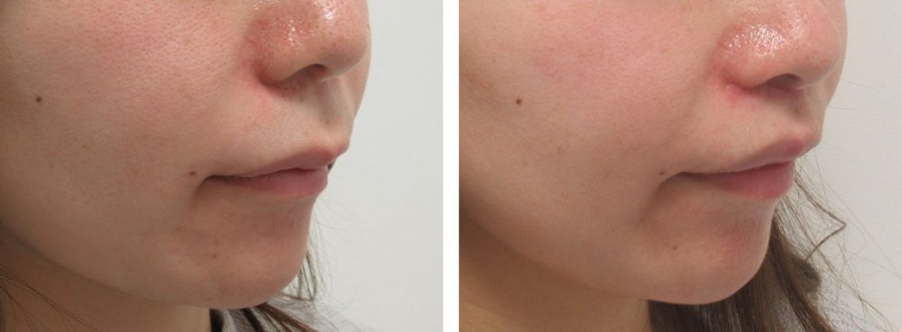 人中短縮術(リップリフト)・外側人中短縮術の症例写真 施術前後 １週間
