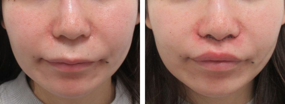 人中短縮術(リップリフト)・外側人中短縮術の症例写真 施術前後 直後