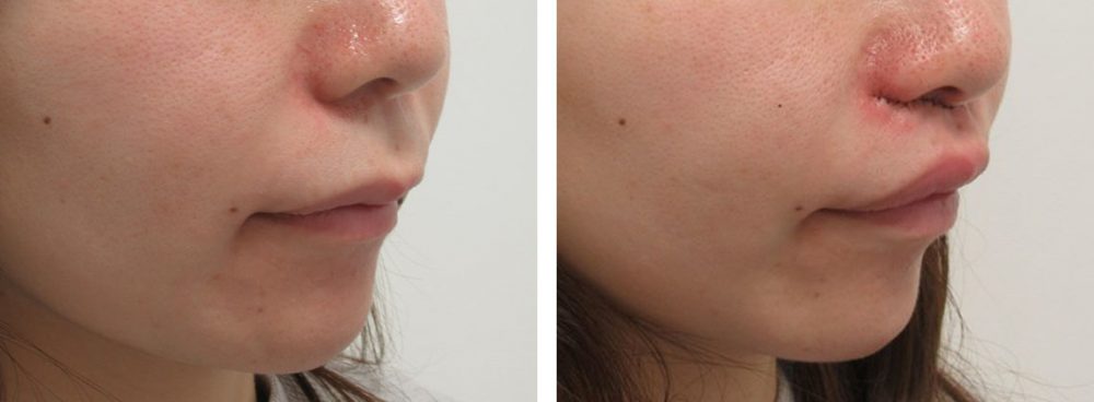 人中短縮術(リップリフト)・外側人中短縮術の症例写真 施術前後 直後