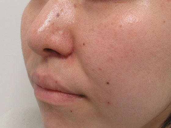 鼻の他院修正オペ 症例写真 Taクリニック 美容整形 美容外科 新宿 銀座 大阪 福岡 高崎