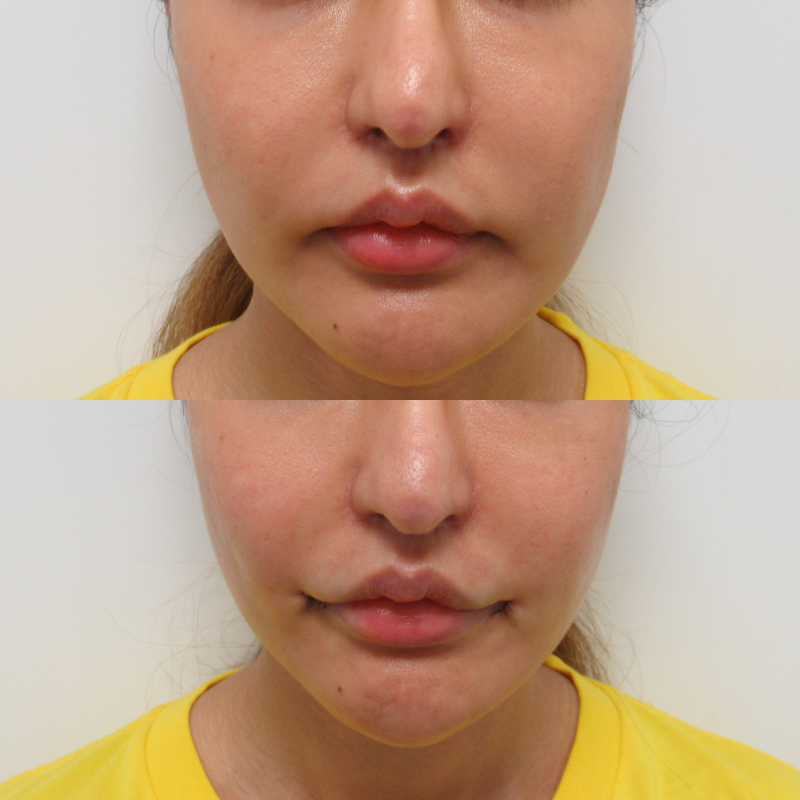 口角リフト（外側人中短縮術）の施術直後