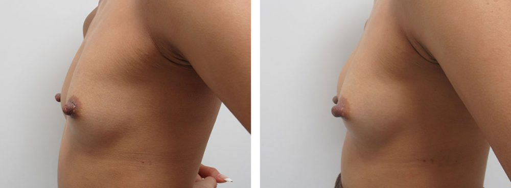 ヒアルロン酸注入豊胸術（グラビアバスト）の症例写真 施術前後 １週間