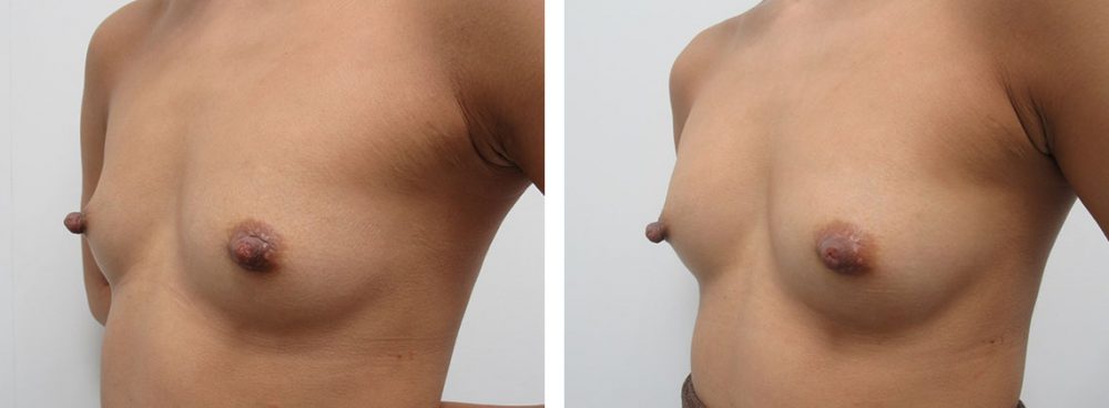 ヒアルロン酸注入豊胸術（グラビアバスト）の症例写真 施術前後 １週間