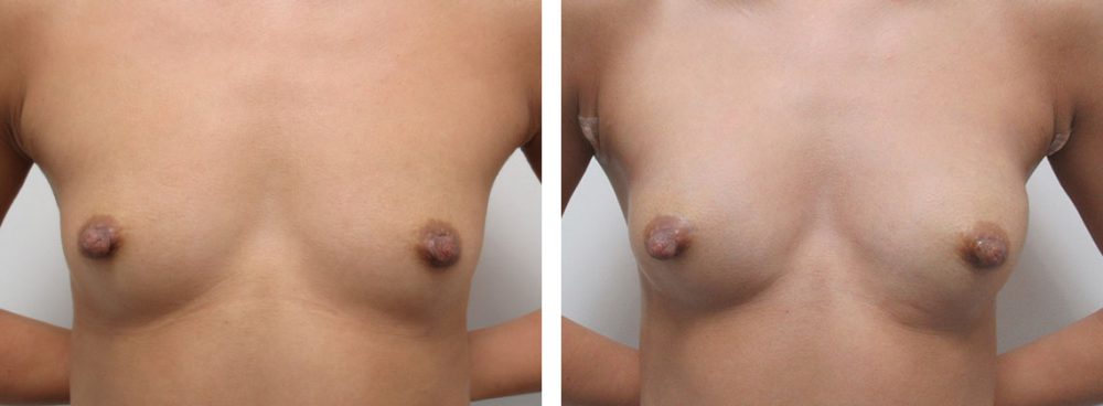 ヒアルロン酸注入豊胸術（グラビアバスト）の症例写真 施術前後 直後