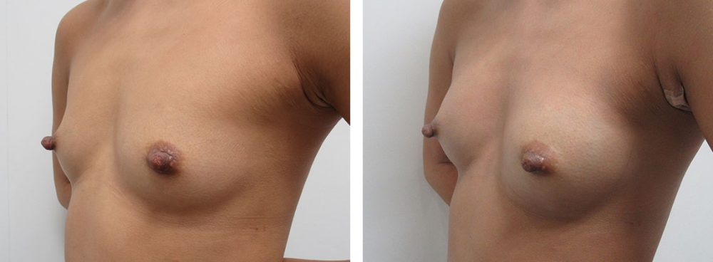 ヒアルロン酸注入豊胸術（グラビアバスト）の症例写真 施術前後 直後