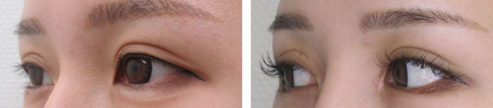 目尻靭帯移動術/グラマラスライン（タレ目形成）/目頭切開術の症例写真 施術前後 １ヵ月